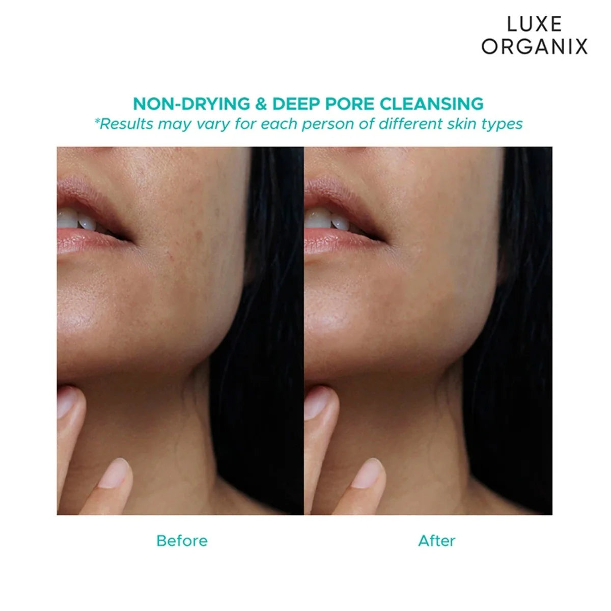 Luxe Organix Miracle Solutions Acne Derm+ Gel Cleanser