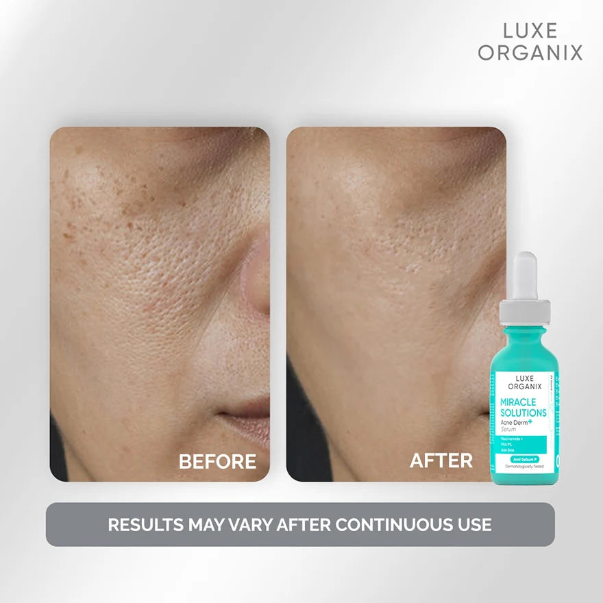 Luxe Organix Miracle Solutions Acne Derm+ Serum