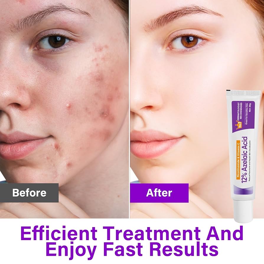 Azelaic Acid Cream
