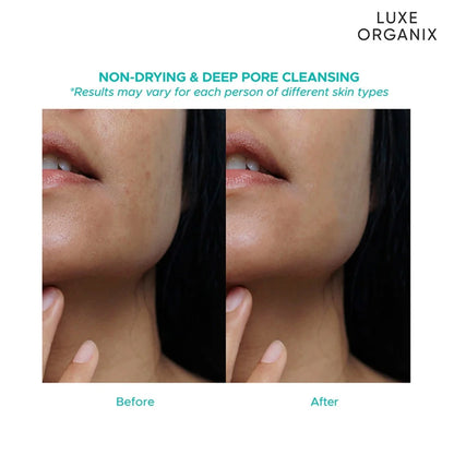 Luxe Organix Miracle Solutions Acne Derm+ Gel Cleanser